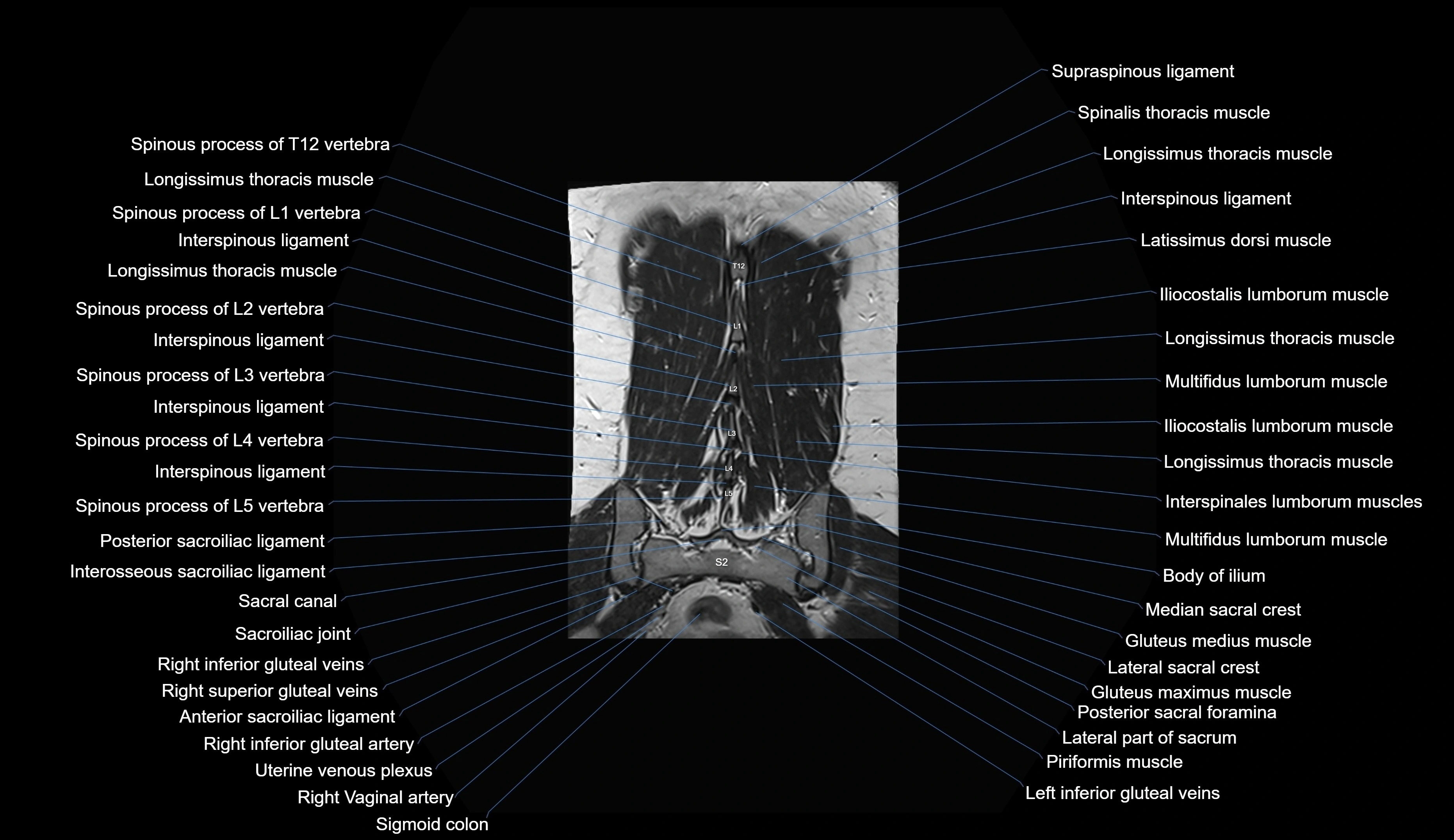 MRI lumbar spine coronal cross sectional anatomy 3T radiology  image-img-00001-00032.webp